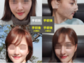 当院で鼻の手術を受け  た患者様の自撮り写真  です。