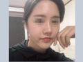 当院で鼻の手術を受けたした患者さんの自撮り写真です。