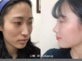 当院で鼻の整形をされた患者さんの自撮りです。