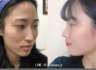 当院で鼻の整形をされた患者さんの自撮りです。