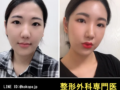 顔面脂肪移植を受けた患者さんの自撮り写真です。