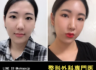 顔面脂肪移植を受けた患者さんの自撮り写真です。