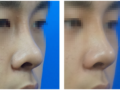 鼻の再手術