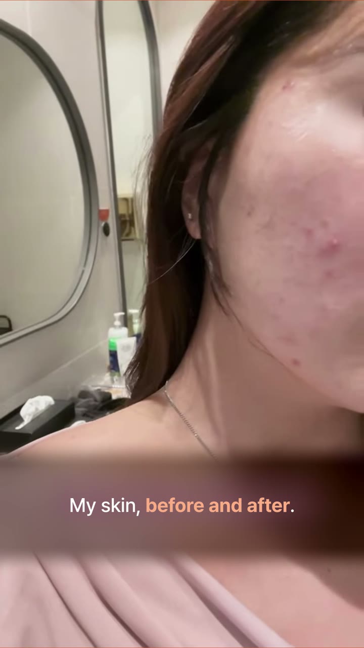 Her Acne Journey: 2 to 10 Sessions