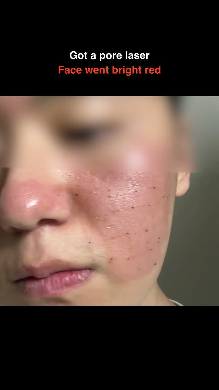 Pore laser. A flushed, dotted face.