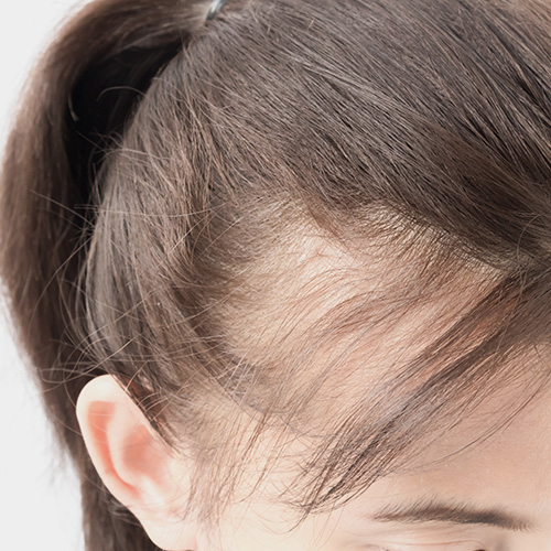 Localized hair loss resulting in circular bald spots.