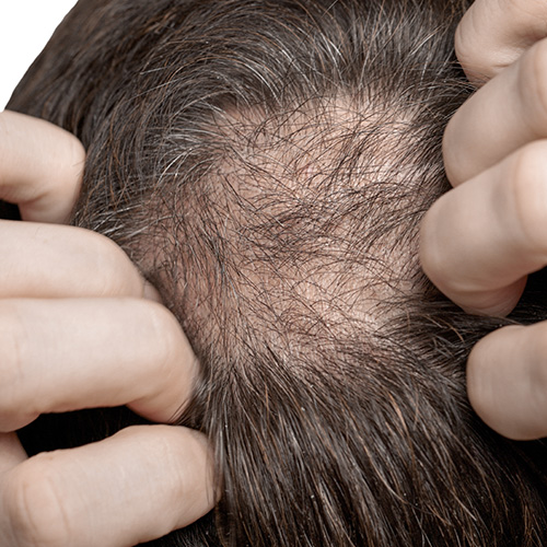 Thinning hair at the crown caused by hormones, extreme dieting, or genetics.