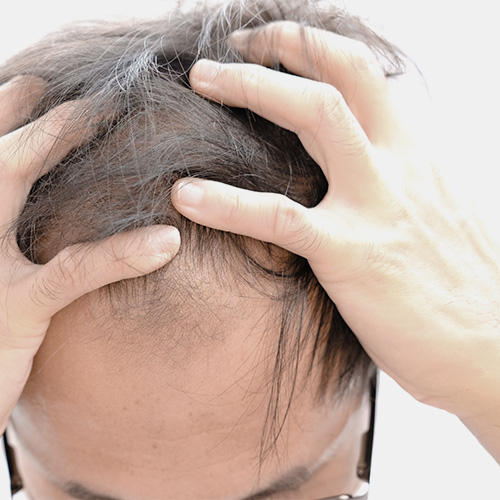 Hair loss due to overproduction of male hormones, genetic factors, or stress.