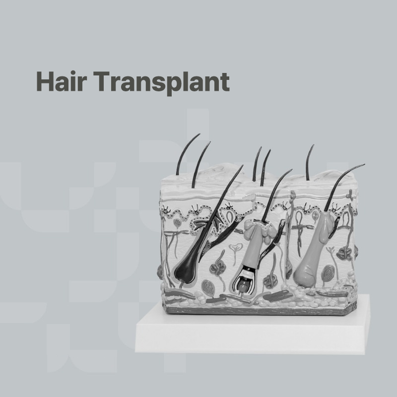 Detailed illustration of a hair transplant procedure involving hair follicles