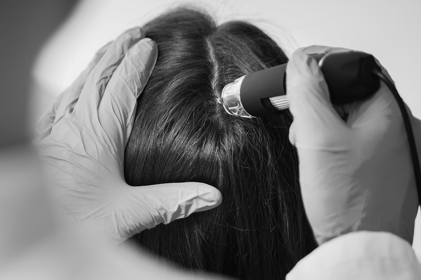 Close-up of a specialist using a device to examine a patient's scalp for hair loss restoration and promoting healthy hair roots at Oganacell Premium Foreigner-friendly Dermatology Clinic, Gangnam branch (Cheongdam), Seoul, South Korea.