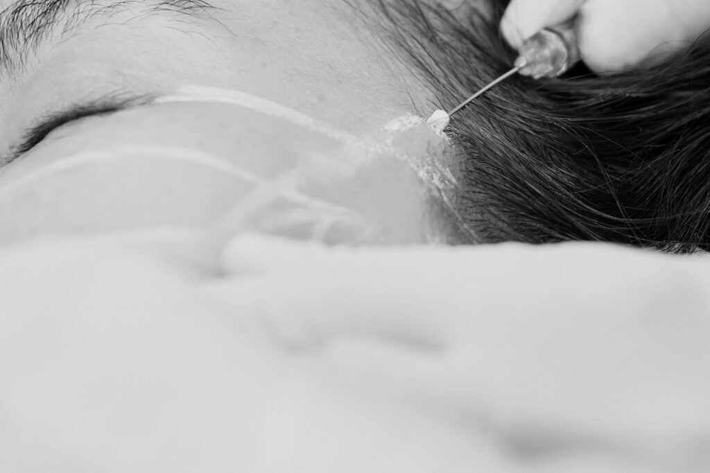 Applying PDO thread for a sharper V-line face contouring to create a natural and enhanced face shape.