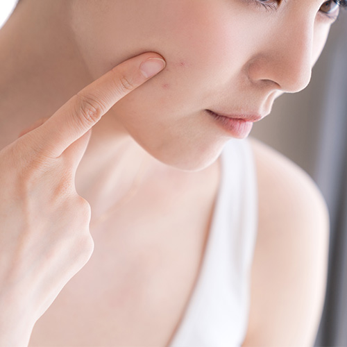 Acne scar treatment for adults