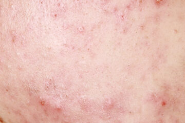 Slow recovery from comedonal acne and sensitive skin acne