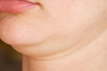 Close-up of double chin, creating synergy with dieting
