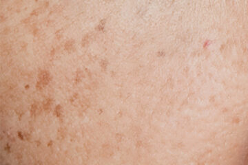 Prevent Blemish - Close-up of Blemished Skin