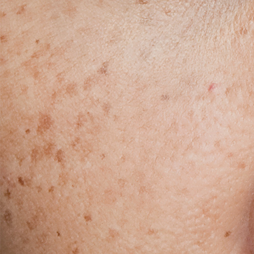 Prevent Blemish - Close-up of Blemished Skin