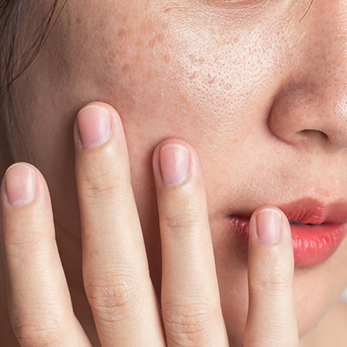 Improving Uneven Skin Tone - Uneven Skin Texture