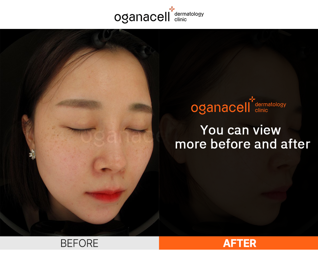 Oganacell skin treatment before and after comparison of a woman's face showing improved skin texture