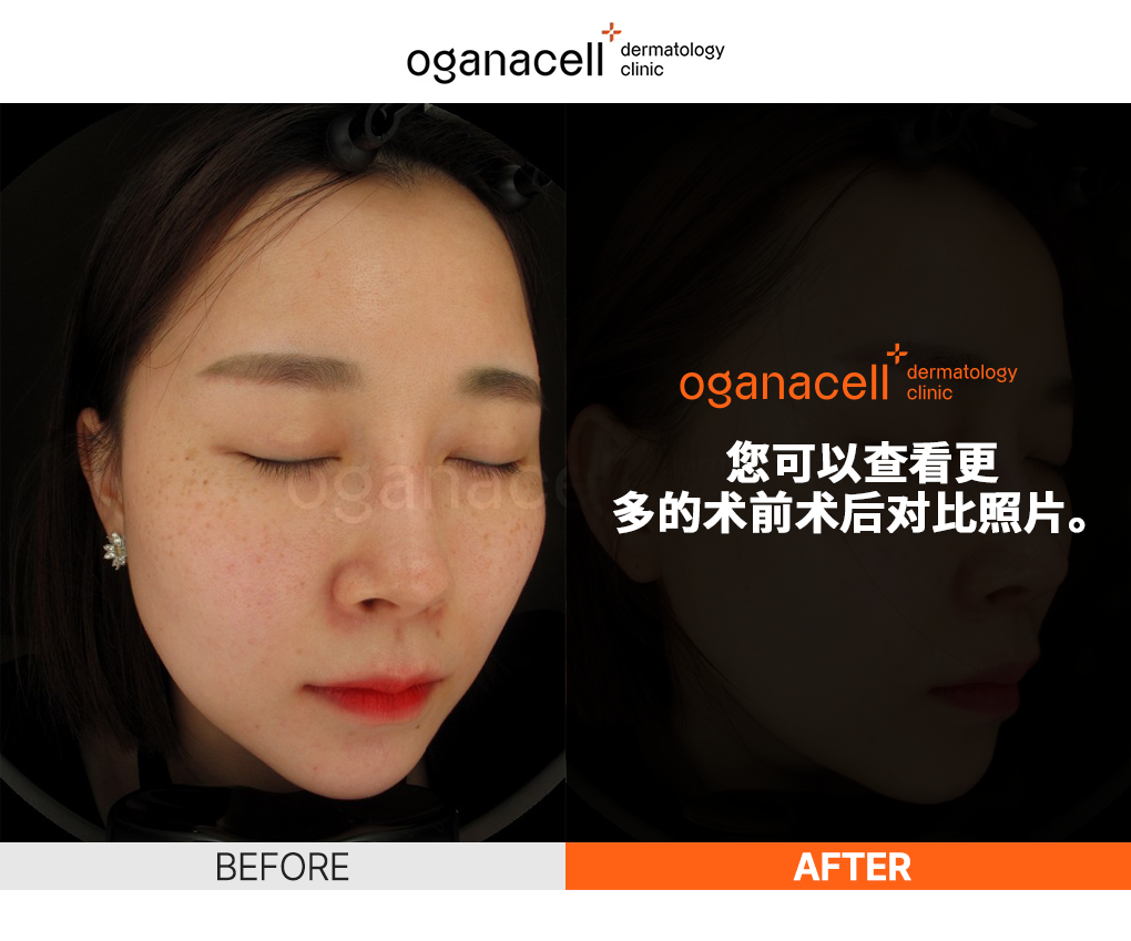 皮肤科皮肤管理前后对比图片