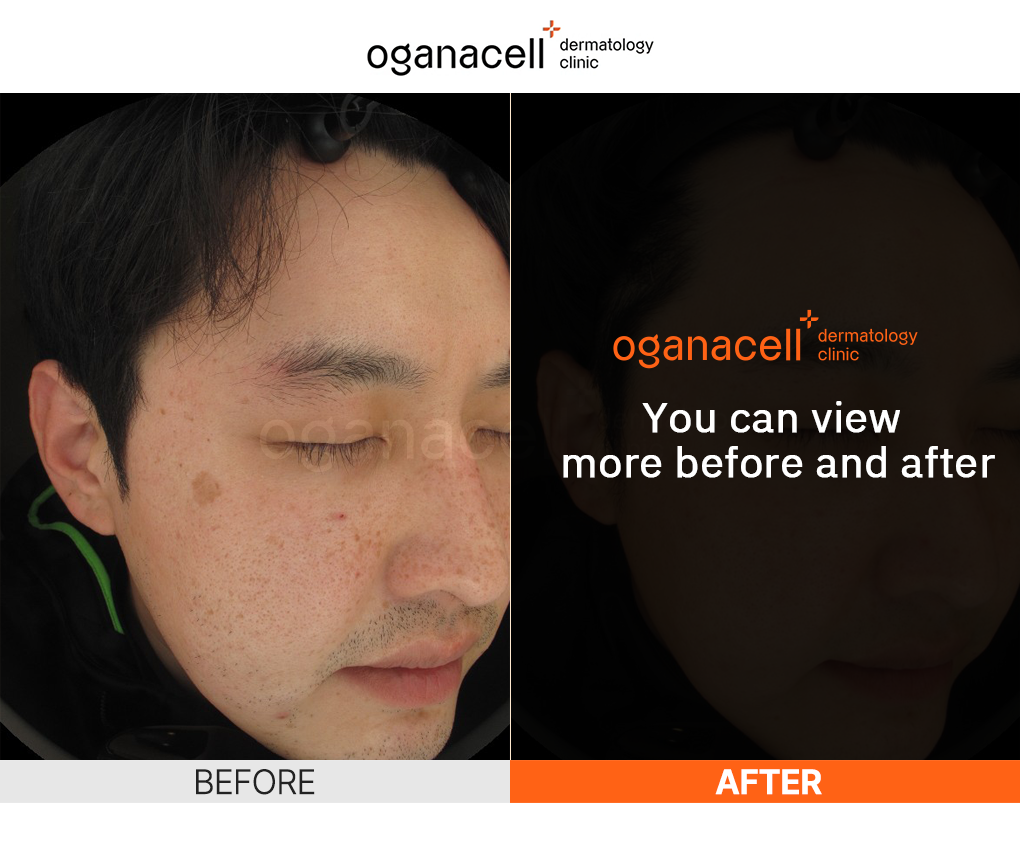 Oganacell skin rejuvenation before and after results on a man's face highlighting reduced wrinkles