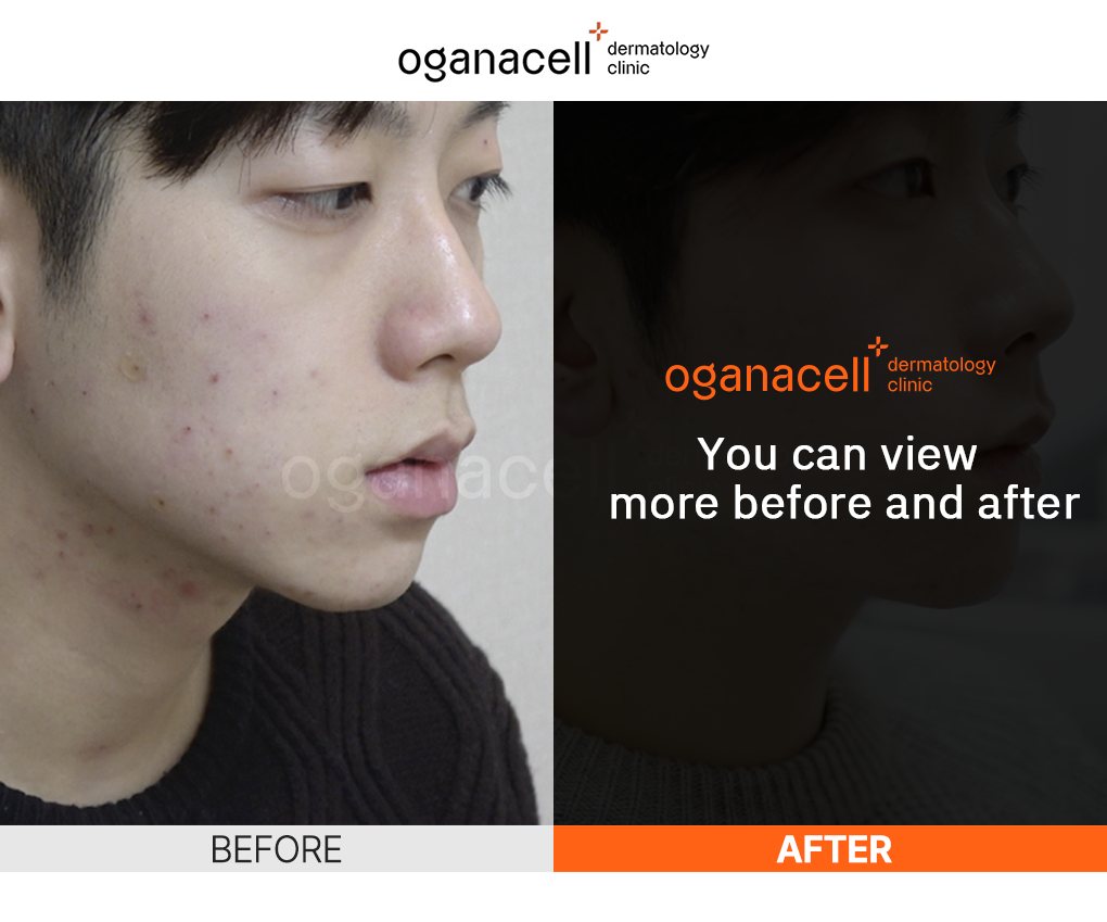 Oganacell severe acne treatment before and after results showing significant acne reduction