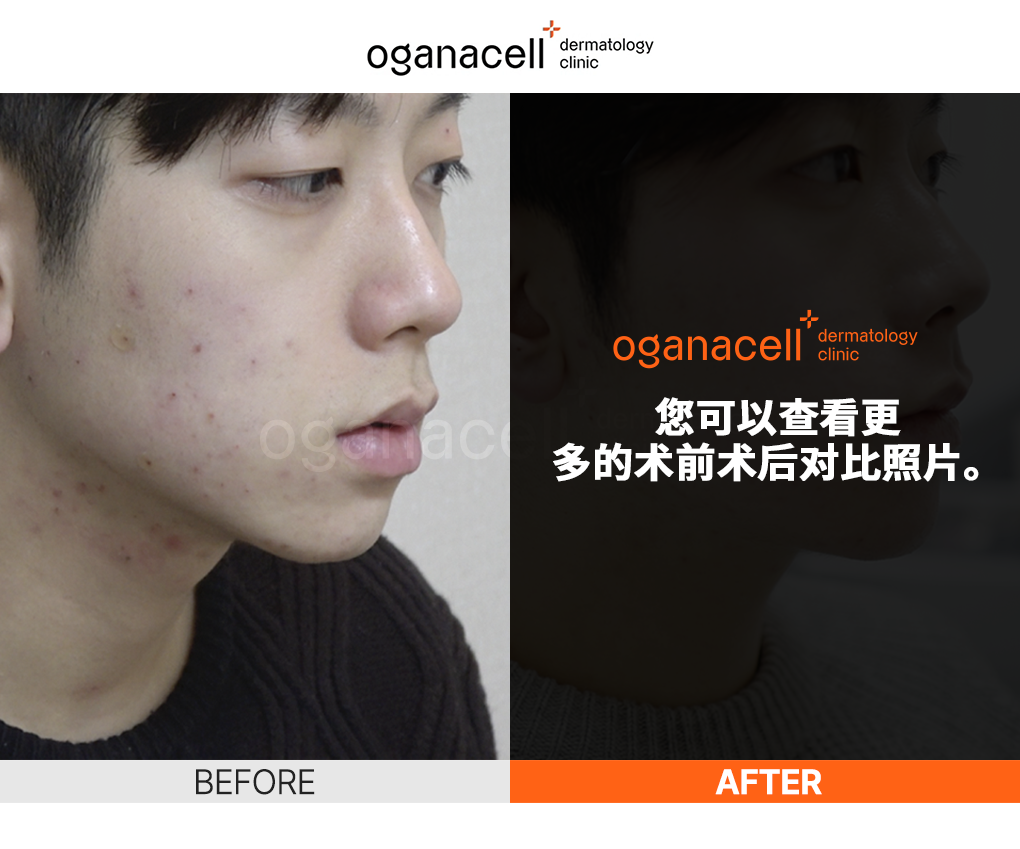 皮肤科皮肤管理前后对比图片