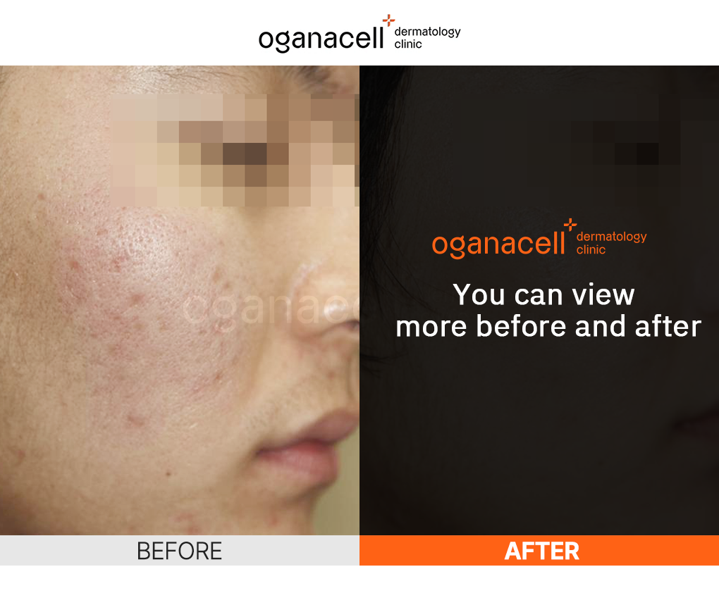 Oganacell pore minimizing treatment before and after with improved skin texture and smaller pores