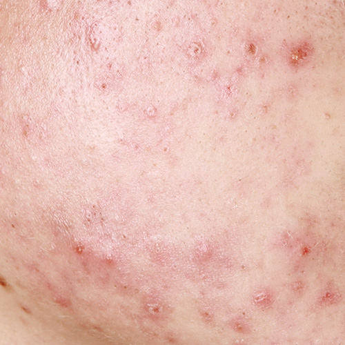 Close-up of comedonal acne, purulent acne, and acne on sensitive skin showing inflammation and redness