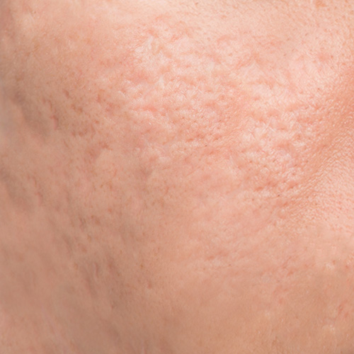 Close-up view of deep acne scars on skin surface, illustrating severe acne scarring issues and texture