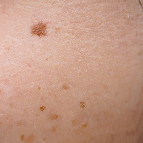 Close-up of dull skin with dark spots showcasing uneven skin tone and pigmentation issues