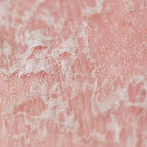 Sore, dry, and flaky skin due to irritation