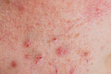 Thin skin with breakouts caused by irritation