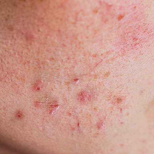 Thin skin with breakouts caused by irritation