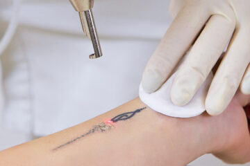Unsuccessful tattoo removal procedure showing partial remnants of a colorful tattoo on the arm.