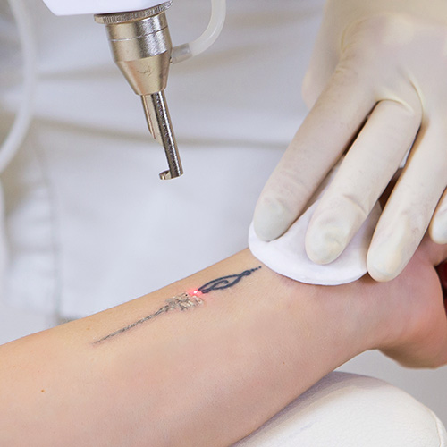 Unsuccessful tattoo removal procedure showing partial remnants of a colorful tattoo on the arm.
