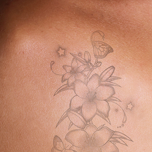 Traumatic tattoo of a flower and butterfly design, highlighting the need for sensitive tattoo procedures.
