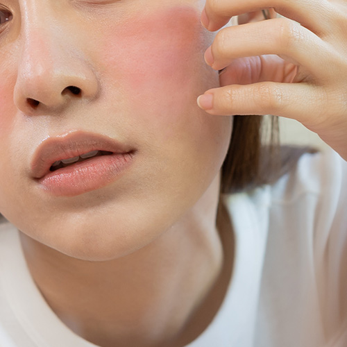 Individual with severe facial redness, possible skin condition or allergic reaction