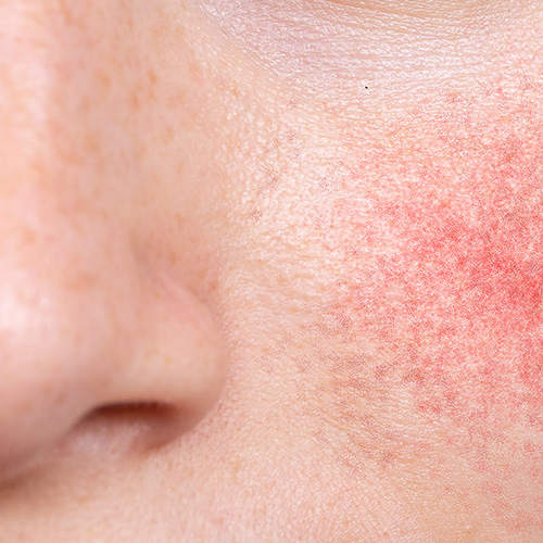Close-up of facial redness around the nose and cheeks indicating skin irritation or rosacea