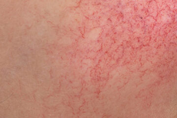 Visible red spider veins and broken capillaries on clear skin