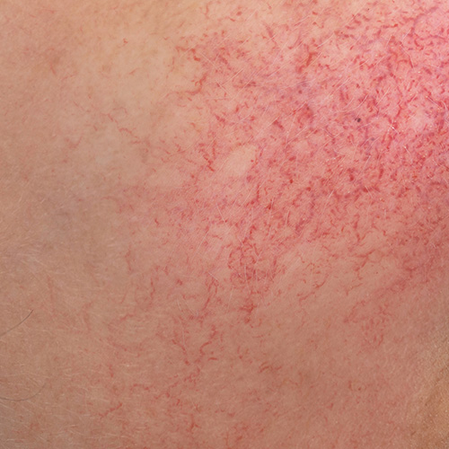 Visible red spider veins and broken capillaries on clear skin
