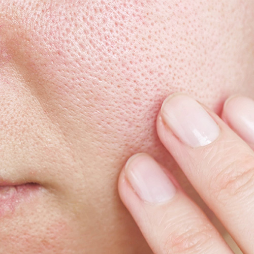 Close-up of facial skin with enlarged pores, redness, and inflammation due to excess sebum production and dermatitis.