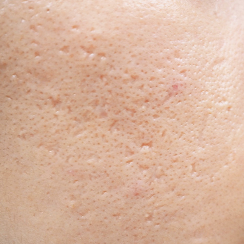 Close-up of skin with acne scars and large pores, effective skincare treatments for improved skin texture