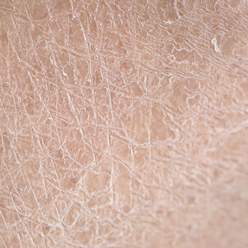 Close-up Image of Severely Dry Skin Showing Cracks and Flakiness