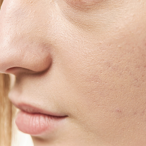 Close-up of rough and dull skin texture on a woman's face, showcasing uneven skin tone and imperfections.