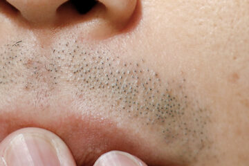 Close-up of facial hair on upper lip causing discomfort, highlighting issue of unwanted body hair