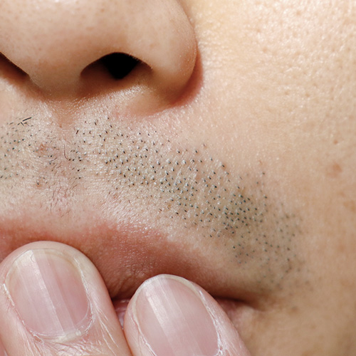 Close-up of facial hair on upper lip causing discomfort, highlighting issue of unwanted body hair