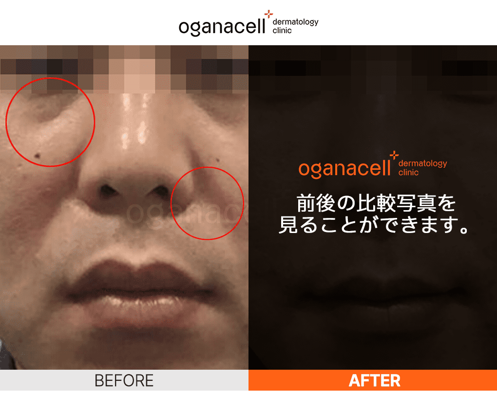 韓国ソウルのプレミアム皮膚科、オガナセルの施術前後の写真です。 クリックして、より多くの写真を確認してください。