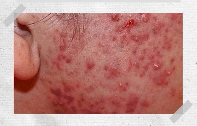 acne scar treatment at Oganacell Premium Foreigner-friendly Dermatology Clinic, Gangnam branch (Cheongdam), Seoul, South Korea.