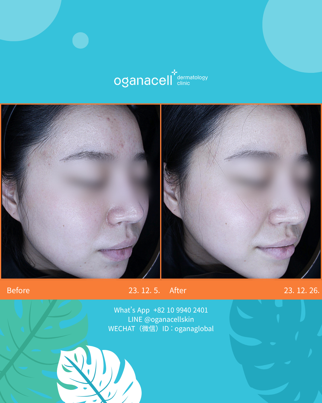before and after at Oganacell Premium Foreigner-friendly Dermatology Clinic, Gangnam branch (Cheongdam), Seoul, South Korea.
