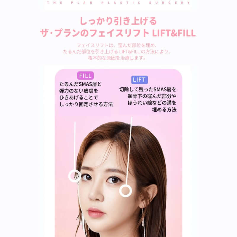 韓国切開リフト